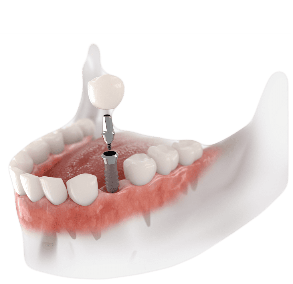 Dental Implant In Turkey Avedent Turkey Dental Clinic