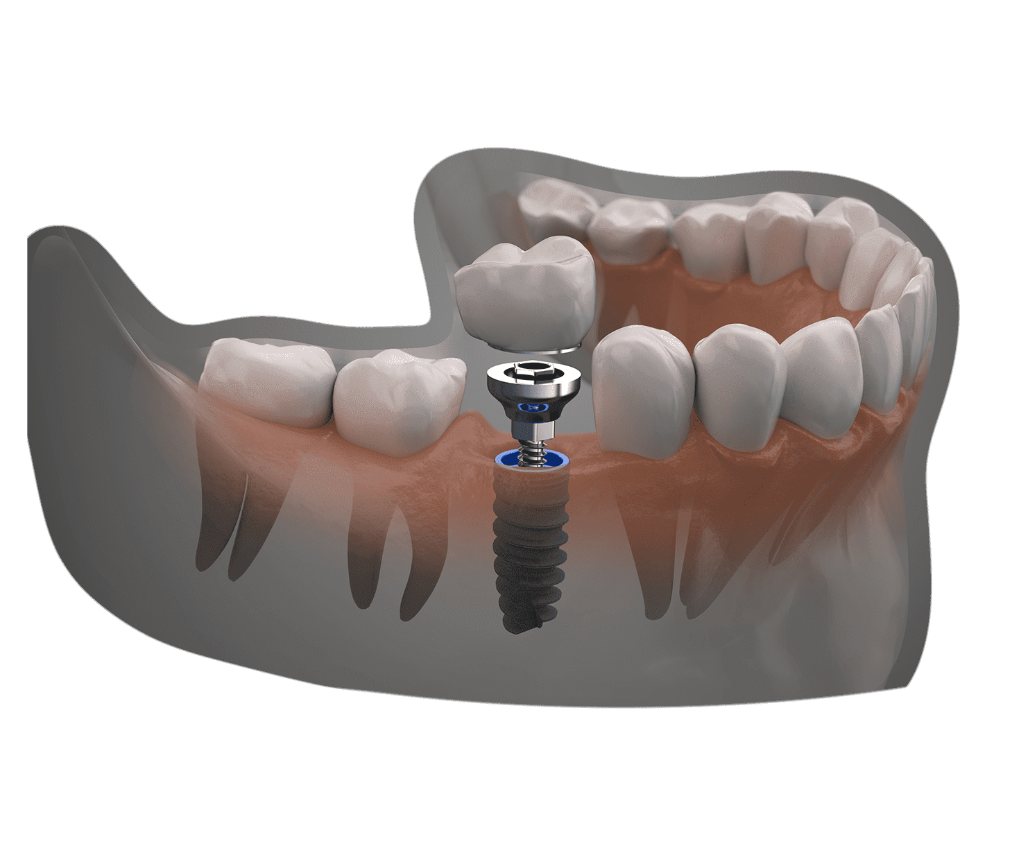 Dental Implants | Avedent Turkey Dental Clinic