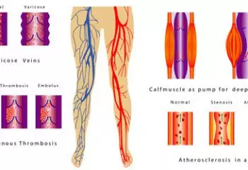 Diagram of varicose veins, deep venous thrombosis, atherosclerosis in the artery and calf muscle pump