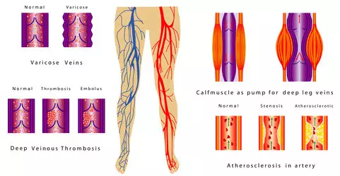 Diagram of varicose veins, deep venous thrombosis, atherosclerosis in the artery and calf muscle pump