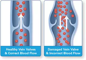 Understanding Chronic Venous Insufficiency: Causes, Symptoms, and Risk  Factors - Advanced Heart and Vascular Institute