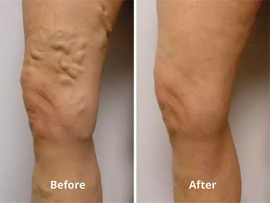 vein treatment before and after