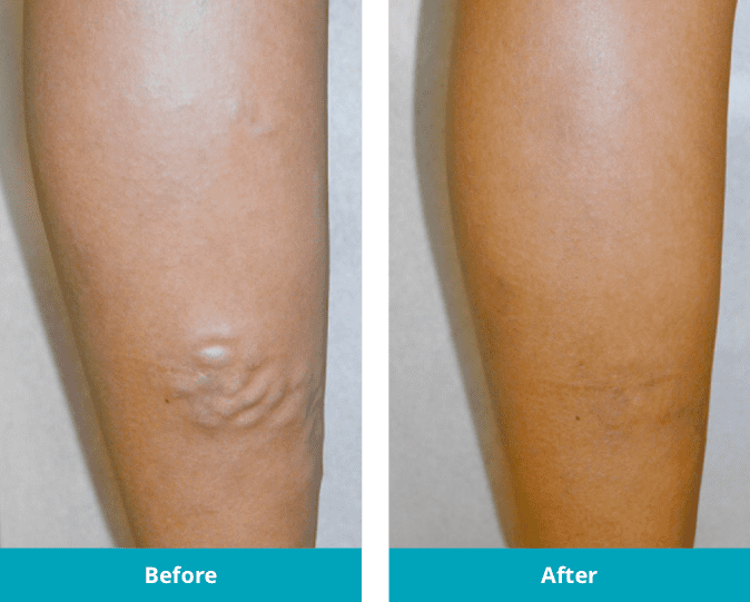 Before and After large bulgin varicose veins