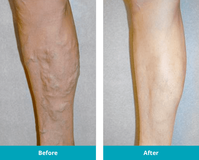 Spider Vein Treatment Yuma  The Vein Center of Arizona