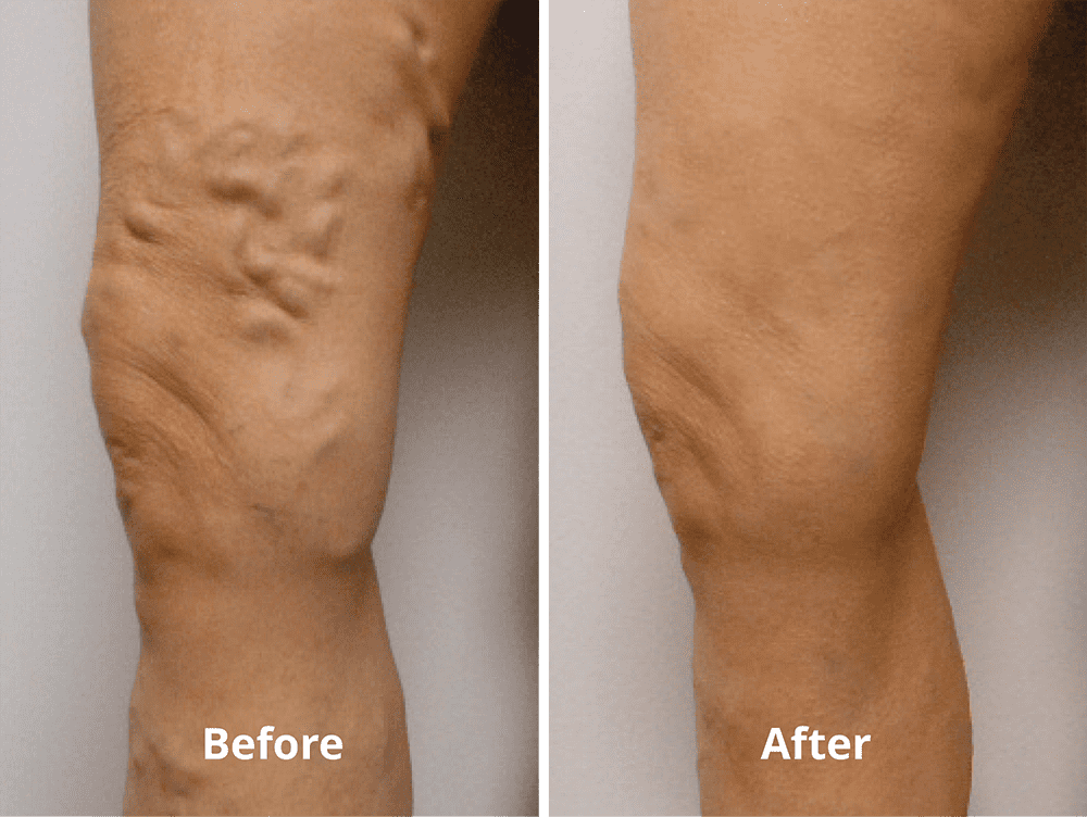 Compression Stockings & Conservative Therapy for Varicose Veins