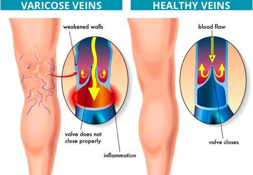 Imaging test for varicose veins - Health Images